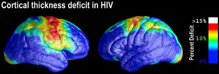 HIV brain scan